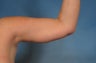Arm Lift