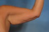 Arm Lift