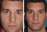 Male Patient Revision Rhinoplasty