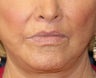 Corner of Lip Lift for "Sad" Expression