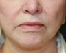 Corner of Lip Lift for "Sad" Expression