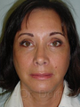 Facelift