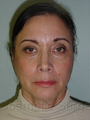 Facelift