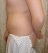 Laser Liposuction