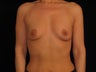 Bilateral Breast Augmentation
