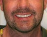 32 year old male treated with All-on-4 Dental Implant Procedure