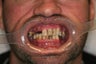 32 year old male treated with All-on-4 Dental Implant Procedure