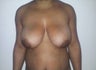 breast lift