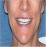 Female Receives Dental Implants