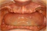 Female Receives Dental Implants