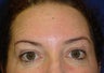 Forehead Lines