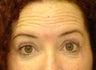 Forehead Lines