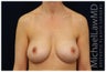Breast Augmentation
