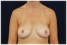 Breast Augmentation