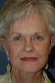 Brow lift and Face lift