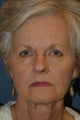 Brow lift and Face lift