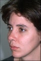 Rhinoplasty