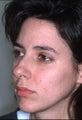 Rhinoplasty