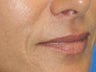 Mole Removal