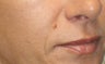 Mole Removal