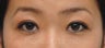 Young Asian female underwent Asian upper blepharoplasty to create double eyelid crease