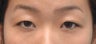 Young Asian female underwent Asian upper blepharoplasty to create double eyelid crease