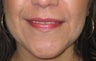 Mole Removal of Lip Using Plastic Surgery Techniques