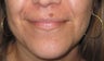 Mole Removal of Lip Using Plastic Surgery Techniques