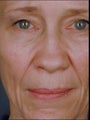 Female Revision Rhinoplasty