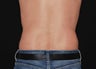 CoolSculpting