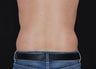 CoolSculpting