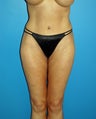 liposuction body