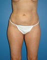 liposuction body