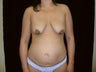 Breast Lift with Short Vertical Scar