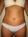 Liposuction