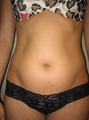 Liposuction