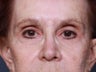 Brow Lift
