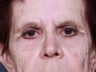 Brow Lift