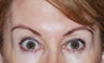 Botox