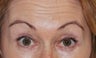 Botox