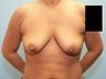39 year old breast lift