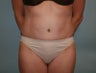 Tummy Tuck