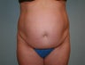 Tummy Tuck