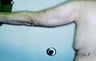 Female patient who underwent an arm lift