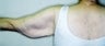 Female patient who underwent an arm lift