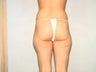 Female Liposuction