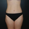 liposuction to abdomen, flanks, lower back