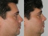 45 Year Old Male for Primary Rhinoplasty