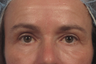 Botox and Juvederm Ultra around the eyes
