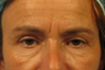 Botox and Juvederm Ultra around the eyes